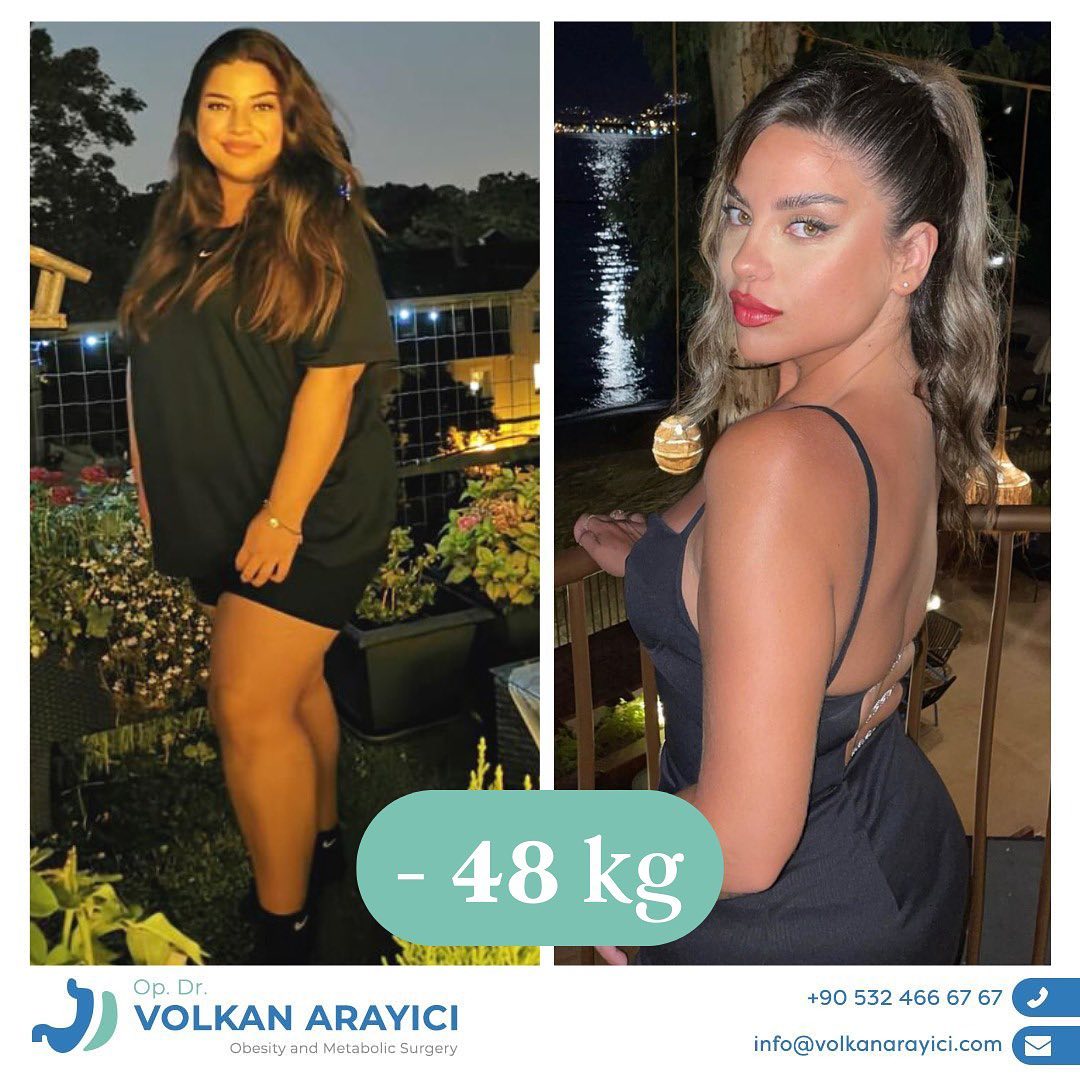 Versicherungsleistungen und die Kosten einer Magenverkleinerung